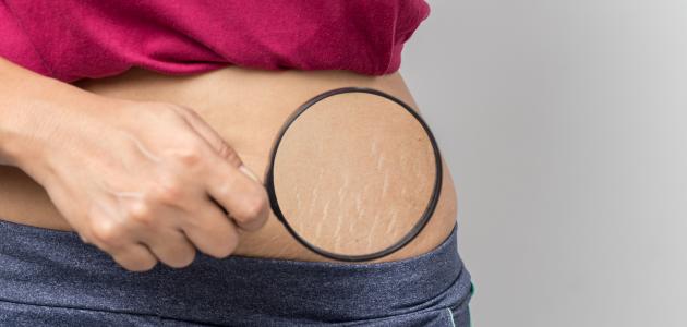 علاج تمدد الجلد اثناء الحمل