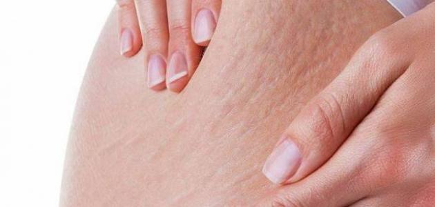 علاج تمدد الجلد أثناء الحمل