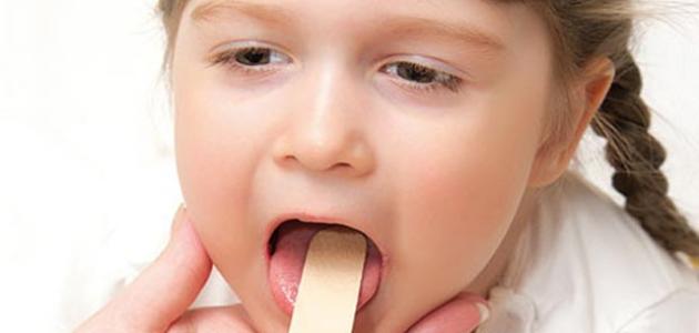 علاج التهاب الحلق عند الأطفال