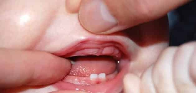 نمو الأسنان عند الأطفال وأهم النصائح لسلامة مرحلة التسنين؟