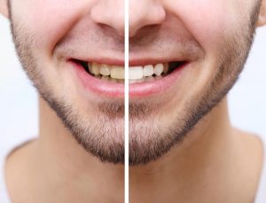 انواع تبييض الاسنان وافضلها